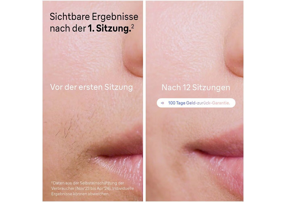 Vergleich der Gesichtshaut vor der ersten Sitzung und nach 12 Sitzungen mit dem Braun Skin i-expert IPL-System.
